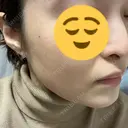 ピコスポット 日比谷セントラルクリニック AFTER サムネイル用