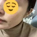 ピコスポット 日比谷セントラルクリニック DAY 11 サムネイル用