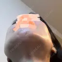 骨削り（エラ） / 骨削り（頬） ボンディ美容整形外科（旧リオン整形外科） DAY 33 サムネイル用