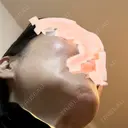 骨削り（エラ） / 骨削り（頬） ボンディ美容整形外科（旧リオン整形外科） DAY 33 サムネイル用