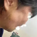 骨削り（エラ） / 骨削り（頬） ボンディ美容整形外科（旧リオン整形外科） DAY 20 サムネイル用