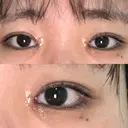 目頭切開 湘南美容クリニック 大阪心斎橋院 DAY 46 サムネイル用