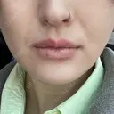 ヒアルロン酸注入（あご） 松倉クリニック 表参道 DAY 1 サムネイル用