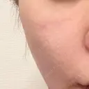 ヒアルロン酸注入（頬） oneUPclinic DAY 4 サムネイル用