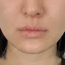 ヒアルロン酸注入（あご） 松倉クリニック 表参道 DAY 2 サムネイル用