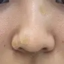 ほくろ・いぼ除去レーザー（肌） Fellez Clinic【フェルズクリニック】 DAY 0 サムネイル用
