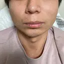 糸リフト / ヒアルロン酸注入（あご） / ボトックス（エラ・小顔） / 脂肪溶解注射（顔） TCB東京中央美容外科 横浜院 DAY 30 サムネイル用