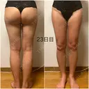 脂肪吸引（脚） / 豊胸（脂肪注入） GAYA body design clinic DAY 23 サムネイル用