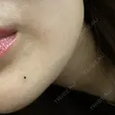 アートメイク（ほくろ） 新宿クレアクリニック DAY 0 サムネイル用