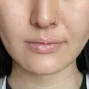 ヒアルロン酸注入（あご） 松倉クリニック 表参道 DAY 3 サムネイル用