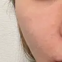 ヒアルロン酸注入（頬） oneUPclinic DAY 5 サムネイル用