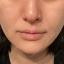 ヒアルロン酸注入（あご） 松倉クリニック 表参道 DAY 4 サムネイル用