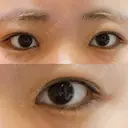 目頭切開 湘南美容クリニック 大阪心斎橋院 DAY 50 サムネイル用