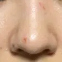 ほくろ・いぼ除去レーザー（肌） Fellez Clinic【フェルズクリニック】 DAY 2 サムネイル用