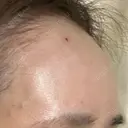 ヒアルロン酸注入（額） / ヒアルロン酸注入（こめかみ） LA CLEF CLINIC（ラクレクリニック） DAY 0 サムネイル用