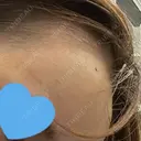 ヒアルロン酸注入（額） / ヒアルロン酸注入（こめかみ） LA CLEF CLINIC（ラクレクリニック） DAY 2 サムネイル用