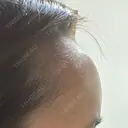 ヒアルロン酸注入（額） / ヒアルロン酸注入（こめかみ） LA CLEF CLINIC（ラクレクリニック） DAY 3 サムネイル用