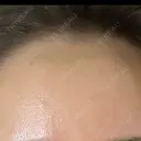 ヒアルロン酸注入（額） / ヒアルロン酸注入（こめかみ） LA CLEF CLINIC（ラクレクリニック） DAY 5 サムネイル用