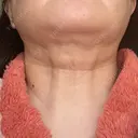 糸リフト / 脂肪吸引（顔） / メーラーファット除去 / ジョールファット除去 湘南美容クリニック 秋葉原院 DAY 62 サムネイル用
