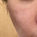 ヒアルロン酸注入（頬） oneUPclinic AFTER サムネイル用