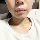 ボトックス（エラ・小顔） 一宮美容クリニック AFTER サムネイル用