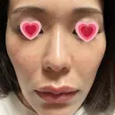 水光注射（ハリ・美肌） 赤羽ここちクリニック DAY 4 サムネイル用