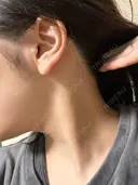 脂肪吸引注射（顔） イテウォンビューティークリニック 名古屋栄院 DAY 112 サムネイル用