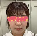 ヴェルヴェットスキン Olino美容外科・美容皮膚科 AFTER サムネイル用
