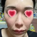 水光注射（ハリ・美肌） 赤羽ここちクリニック DAY 6 サムネイル用