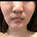 ルメッカ ルラ美容クリニック 大宮院 / ルラスキンクリニック 大宮院 AFTER サムネイル用