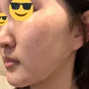 ルメッカ ルラ美容クリニック 大宮院 / ルラスキンクリニック 大宮院 DAY 34 サムネイル用