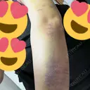 脂肪吸引（二の腕） 藤・ナチュレ美容クリニック 銀座院 DAY 6 サムネイル用