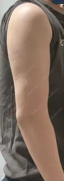 脂肪吸引（二の腕） / 脂肪吸引（脚） / ボトックス（ふくらはぎ） / ボトックス（二の腕） Mods Clinic（モッズクリニック） 福岡院 DAY 99 サムネイル用