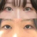 二重埋没 / 目頭切開 シンデレラ＆ダヴィンチクリニック AFTER サムネイル用