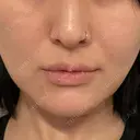 ヒアルロン酸注入（あご） 松倉クリニック 表参道 DAY 8 サムネイル用