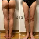 脂肪吸引（脚） / 豊胸（脂肪注入） GAYA body design clinic DAY 29 サムネイル用