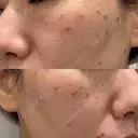 ピコレーザートーニング（美白・肝斑） / ピコスポット BISIN GINZA CLINIC DAY 0 サムネイル用