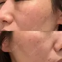 ピコレーザートーニング（美白・肝斑） / ピコスポット BISIN GINZA CLINIC AFTER サムネイル用