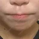 ヒアルロン酸注入（あご） 東京エビスクリニック AFTER サムネイル用