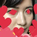 鼻尖形成（切開） / 鼻中隔延長（切開） / 小鼻縮小（切開） / 軟骨移植 / ワシ鼻修正・ハンプ切除 湘南メディカル記念病院（両国） DAY 14 サムネイル用