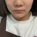 ボトックス（エラ・小顔） 湘南美容クリニック 東京蒲田院 DAY 2 サムネイル用