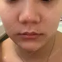 ボトックス（エラ・小顔） 湘南美容クリニック 東京蒲田院 AFTER サムネイル用