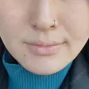 ヒアルロン酸注入（あご） 松倉クリニック 表参道 DAY 11 サムネイル用