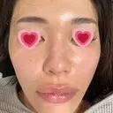 水光注射（ハリ・美肌） 赤羽ここちクリニック DAY 8 サムネイル用