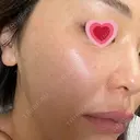 水光注射（ハリ・美肌） 赤羽ここちクリニック DAY 9 サムネイル用