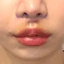 人中短縮 / その他（鼻） 聖心美容クリニック 六本木院 DAY 6 サムネイル用