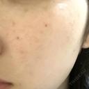 ルメッカ シェリークリニック 新宿本院 AFTER サムネイル用