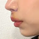 人中短縮 / その他（鼻） 聖心美容クリニック 六本木院 DAY 6 サムネイル用