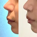 人中短縮 / その他（鼻） 聖心美容クリニック 六本木院 DAY 12 サムネイル用