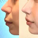人中短縮 / その他（鼻） 聖心美容クリニック 六本木院 DAY 26 サムネイル用